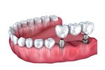 Octo Implant (Istanbul, Sisli, Vali Konagi Avenue, 72), clínica dental