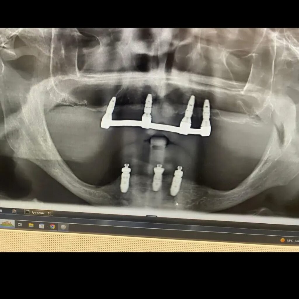 Dental materials and equipment Nta Implant, Eskisehir, photo