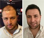Anatolia Hair Transplant - Yeliz Damar (Istanbul, Tuzla, Icmeler Neighborhood, Cagdas Street, 2B) ، مركز طبي، عيادة