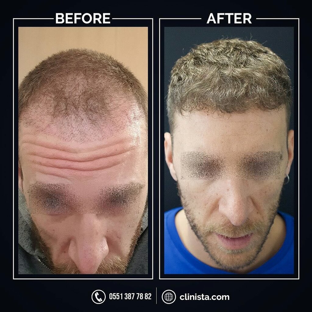 مركز طبي، عيادة Clinista Hair Transplant Center ، اسطنبول، صورة