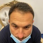 Estbody: Hair Transplant Turkey - Hair Transplant Istanbul (Istanbul, Fatih, Horse Square Avenue) ، وصلات شعر