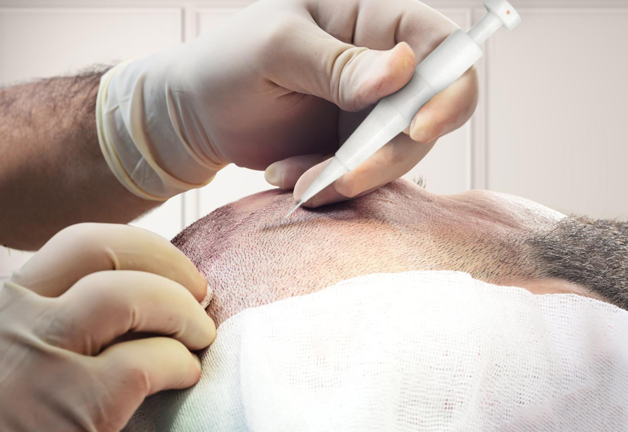 Antalya Hair Transplant - Mediterranean Hair Transplant Turkey
