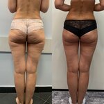 Manual liposuction (Zastavskaya Street, 44), massage salon