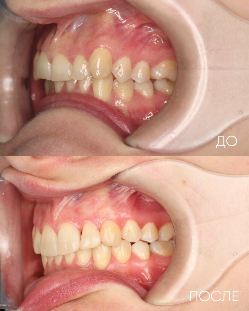 элайнеры для выравнивания зубов цена красноярск