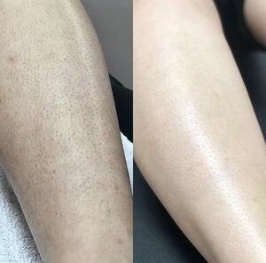 Epiline (Mira Street, 20), hair removal