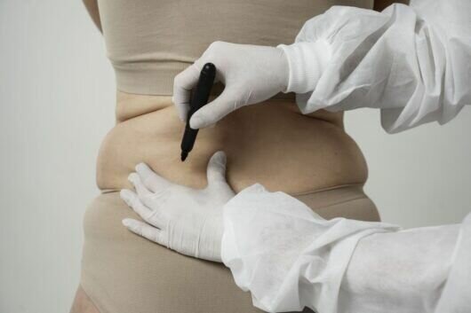Experience Effective Fat Reduction with Lipomatic Treatment in Riyadh