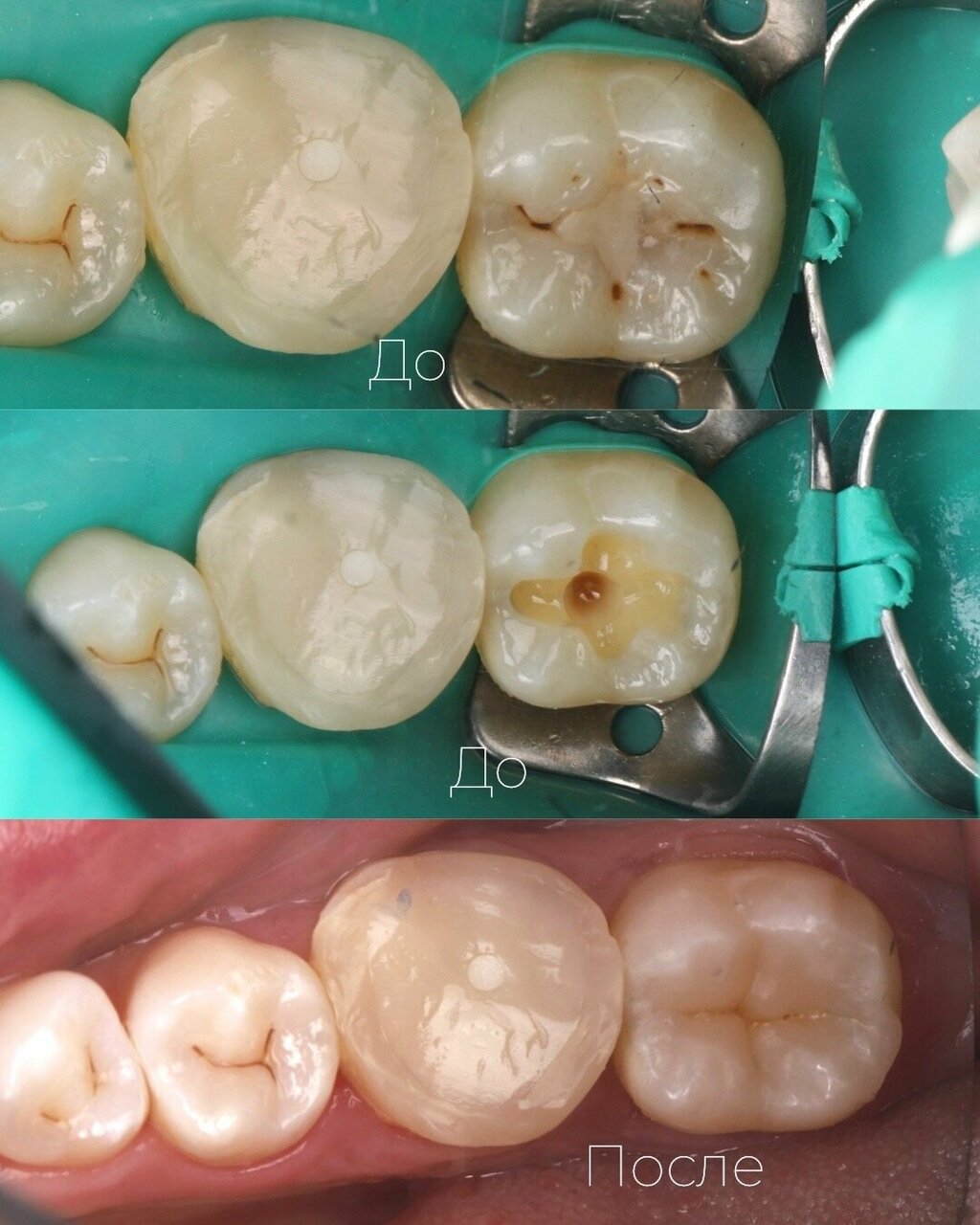 Лечение кариеса красноярск