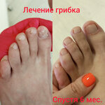 Тяжёлые случаи в подологии, сложные врастания — без операции с Казаковой О. В. (Promyshlennaya ulitsa, 2), podology