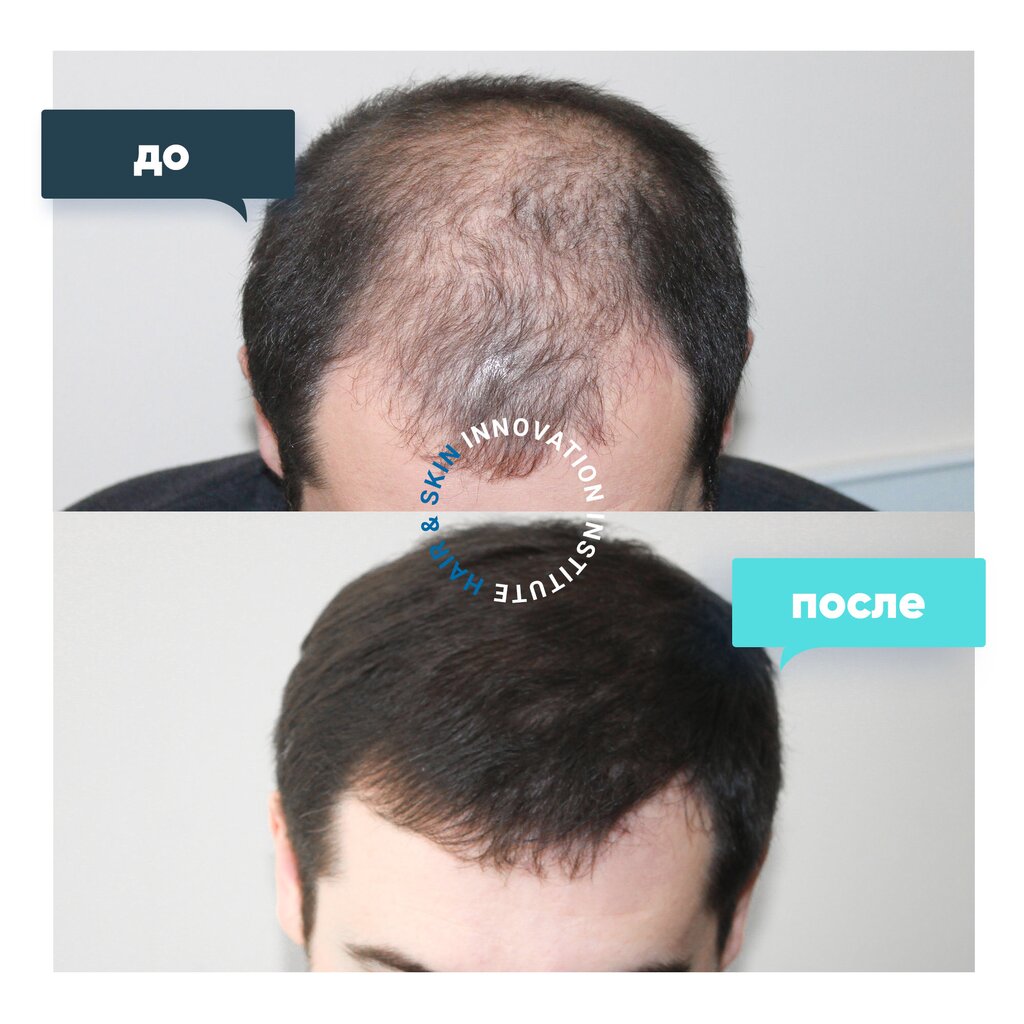 Бебур до пересадки волос и после Панорама: Hair & Skin, косметология, ул. Остоженка, 25, Москва - Яндекс Карты
