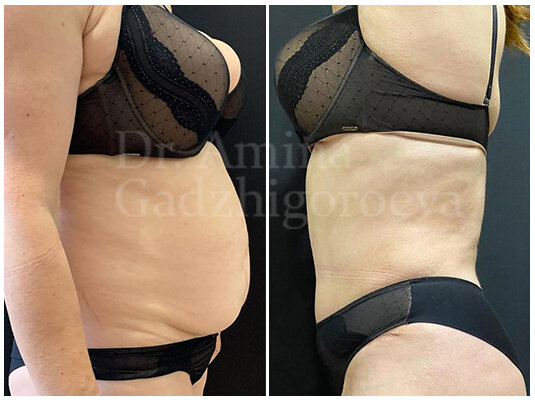 Plastic surgery Пластический хирург Гаджигороева А. К., Makhachkala, photo
