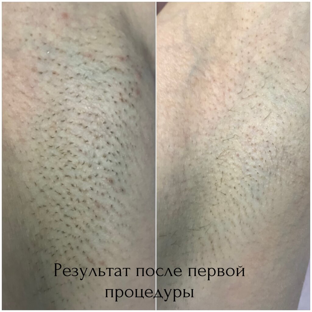 Фотоэпилятор отзывы фото до и после