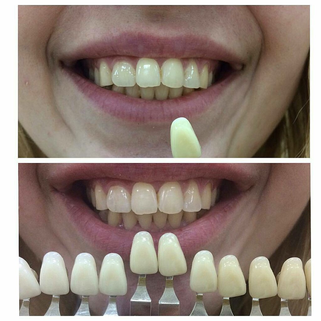 Smile time отбеливание зубов воронеж отзывы ультразвуковая зубная щетка противопоказание