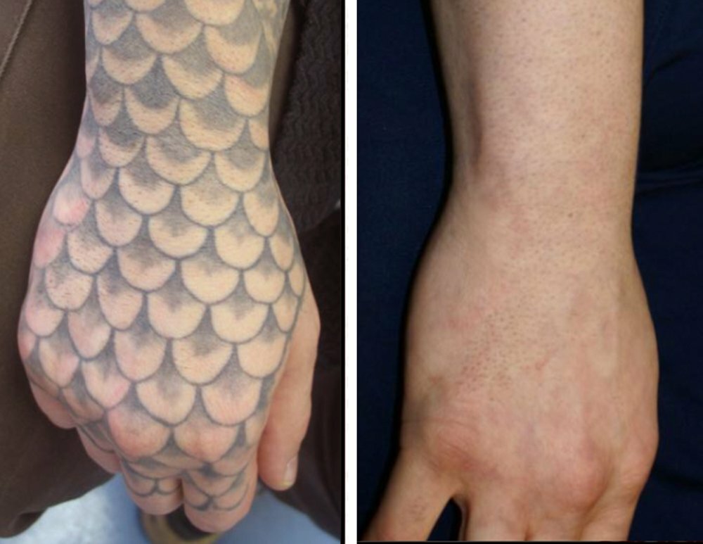 Tattoo studio Inkundū Laser Tattoo Removal Clinic Lexington Ky, Lexington, photo