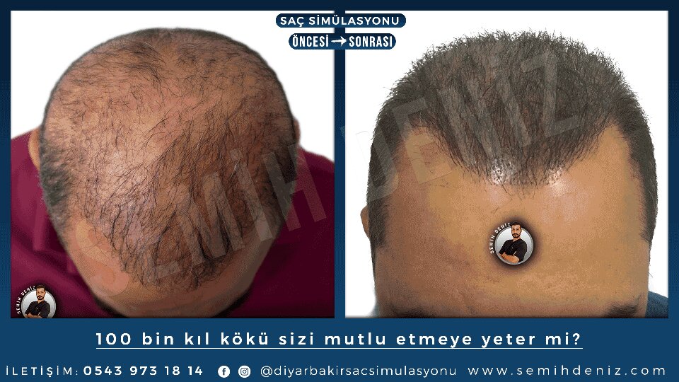 Beauty salon Scalp Micro Pigmentation Semih Deniz, Diyarbakir, photo