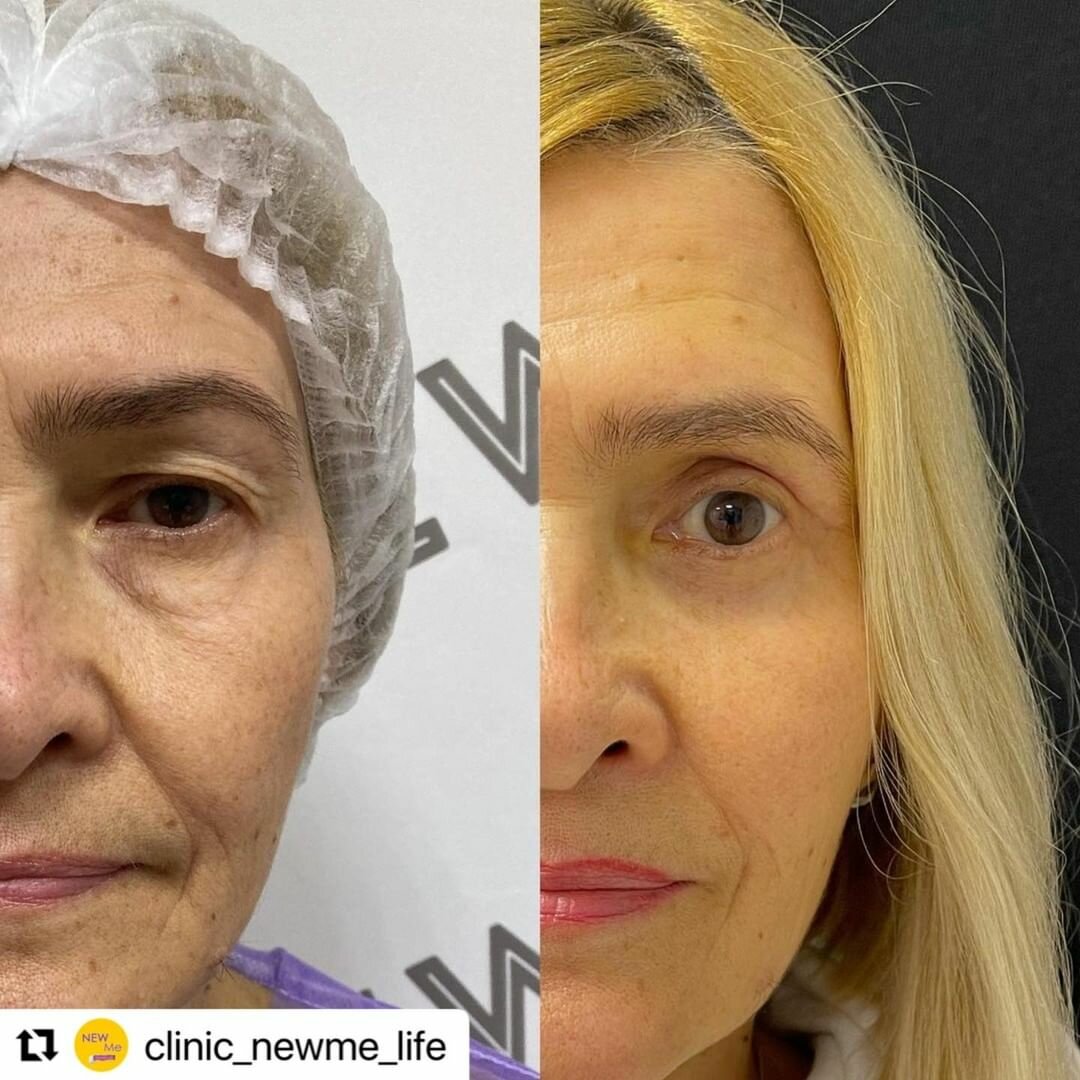 Twitter 上的 Nordesthetics Clinic：