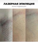 Sevda Clinik (Moscow, Novomoskovskiy Administrative Okrug, Vnukovo District, Anny Akhmatovoy Street, 11к1) ، إزالة الشعر