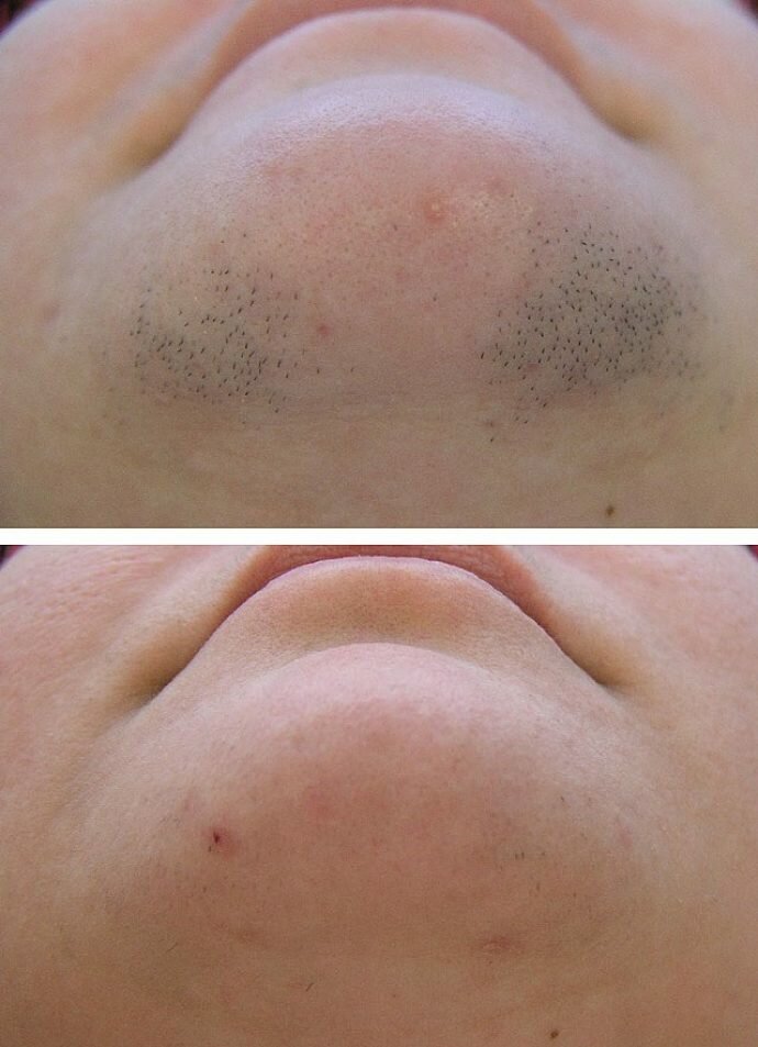 Волосы до и после лазера Permanently closed: Epilyacia Yudino, hair removal, Moscow Region, Odintsovskiy 