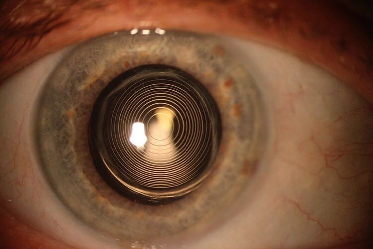 Как выглядит хрусталик глаза Zrenie, vision correction, Rudny, Qazannıñ 40 jıldıq köşesi, 30 - Yandex Maps