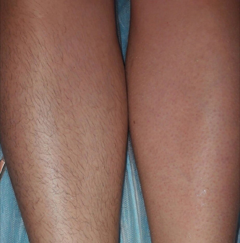 До после картинки шугаринг