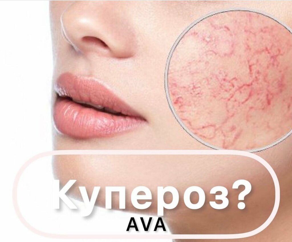 ЭпилСити акция: элос-удаление купероза