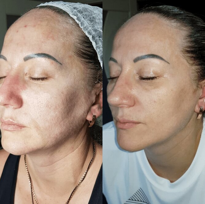 Коллаген в лицо до и после Тканевая маска для лица FOODaHOLIC с коллагеном 3D Natural Essence Mask Collagen