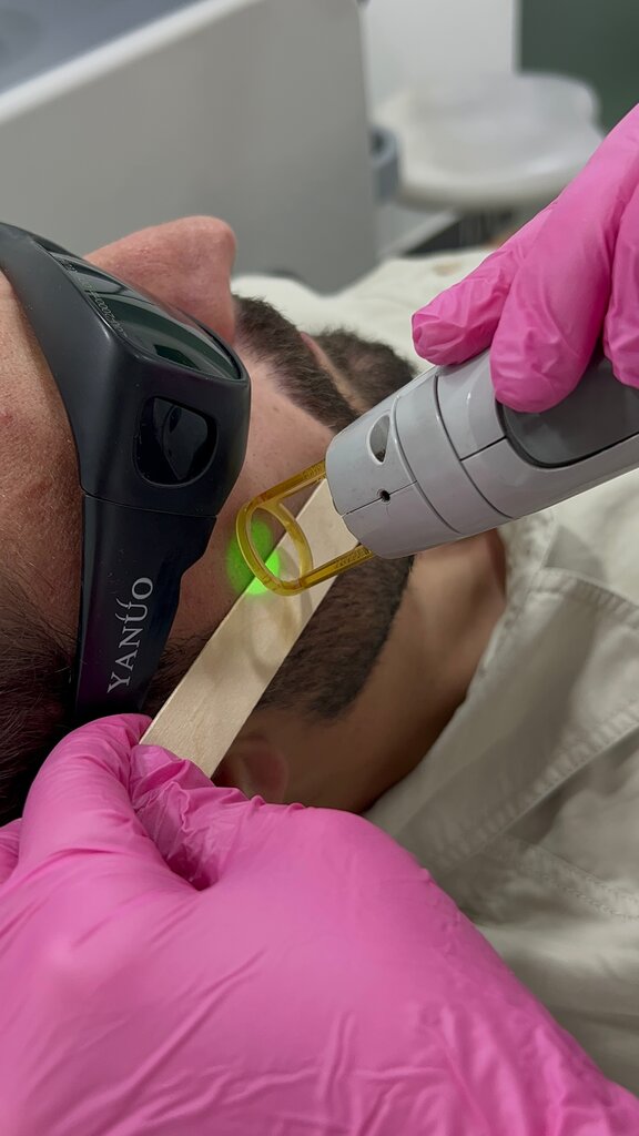 Hair removal Prolase, Yerevan, photo