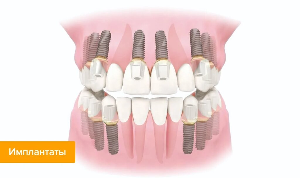 Cuánto cuesta una prótesis dental