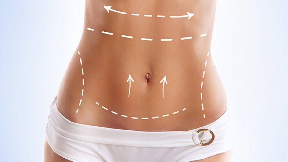 abdominoplasty