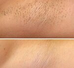 LaserKorolev (50 Let VLKSM street, 6А), hair removal