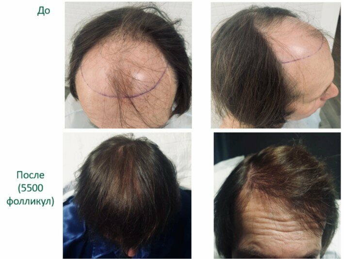 почему выпадают волосы