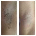 Your laser (Pionerskaya Street, 2), hair removal