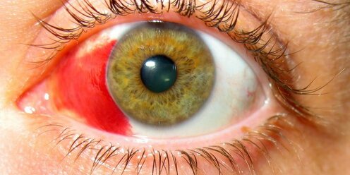 Глаза в лопнувших капиллярах: причины