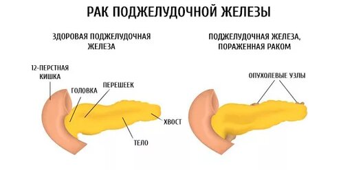 Как проявляется рак поджелудочной железы и как его распознать