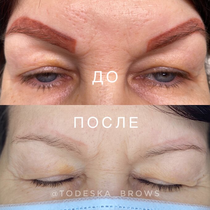 Удаление татуажа бровей лазером