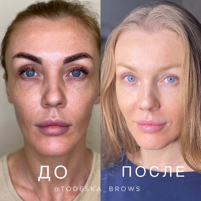 Удаление татуажа бровей ремувером