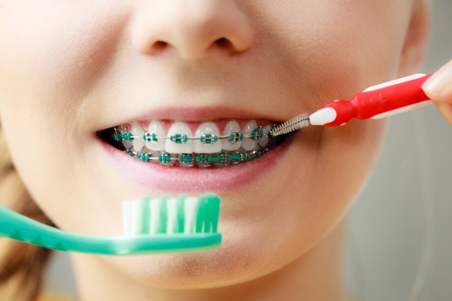 How to properly brush teeth with braces?