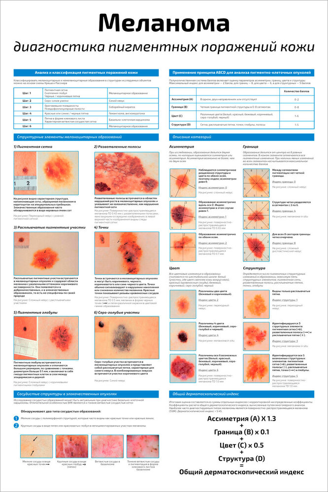 Плакат Квинг Меланома: диагностика пигментных поражений кожи ламинированный 457×610 мм ≈ (А2)