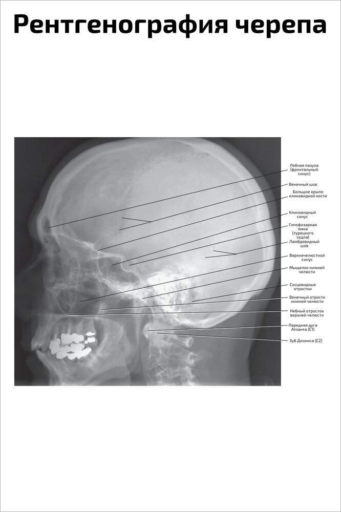 Плакат Квинг Рентгенография черепа: вид сбоку ламинированный 457×610 мм ≈ (А2)