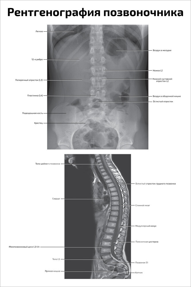 Плакат Квинг Рентгенография позвоночника ламинированный 457×610 мм ≈ (А2)