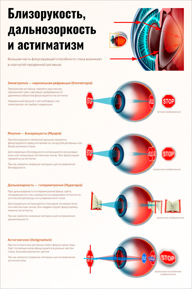 Плакат Квинг Близорукость, дальнозоркость и астигматизм ламинированный 457×610 мм ≈ (А2)