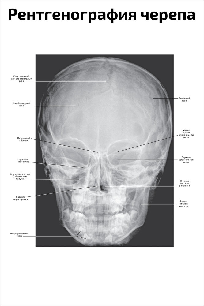 Плакат Квинг Рентгенография черепа ламинированный 457×610 мм ≈ (А2)