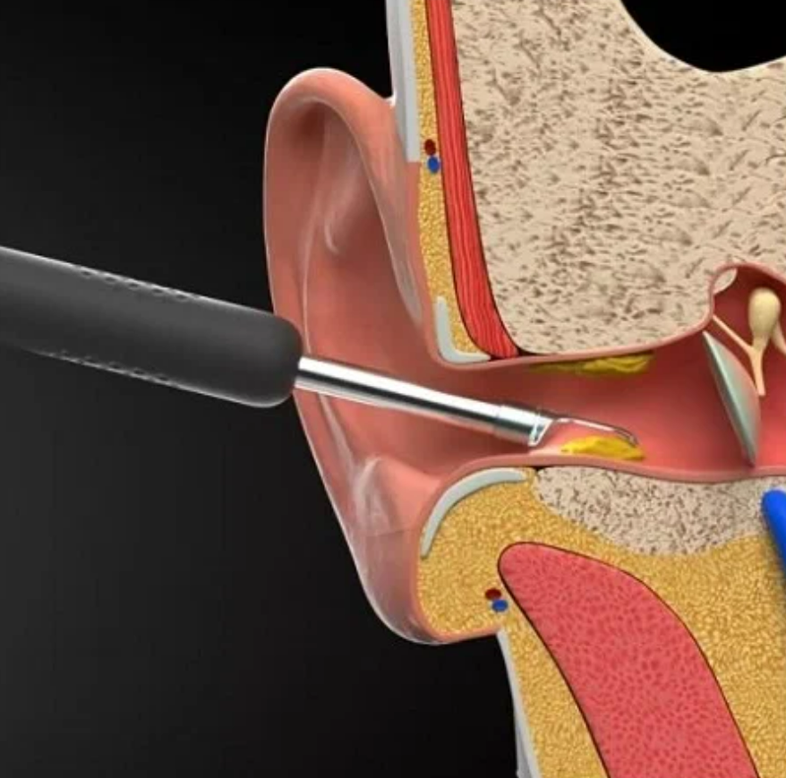 Изображение Умная ушная палочка Xiaomi Bebird Smart Visual Spoon Ear Stick R1 Black