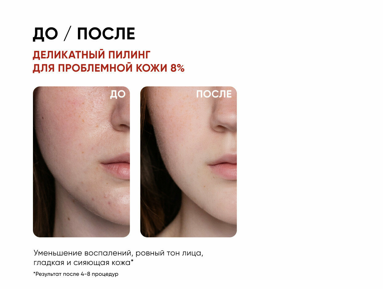 Icon Skin Деликатный пилинг с 8% комплексом кислот для проблемной кожи лица, 30 мл (Icon Skin, ) - фото №11