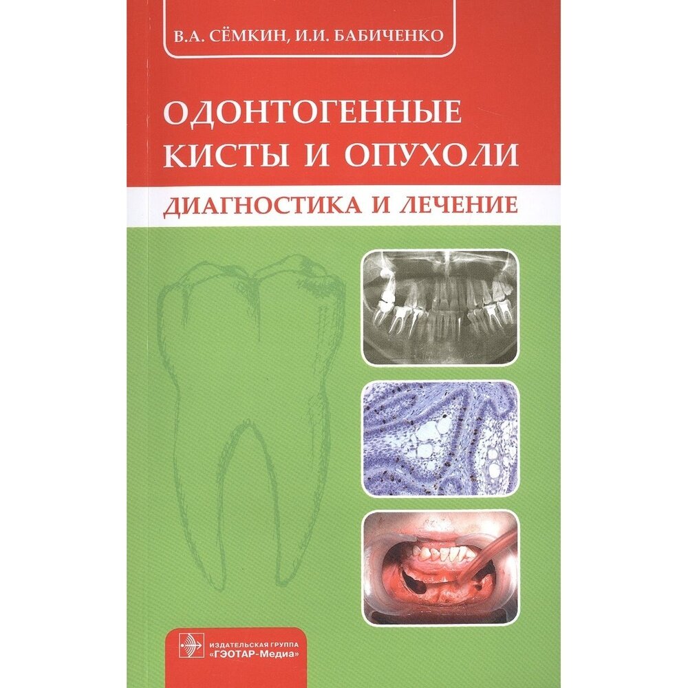 Одонтогенные кисты и опухоли. Диагностика и лечение - фото №5