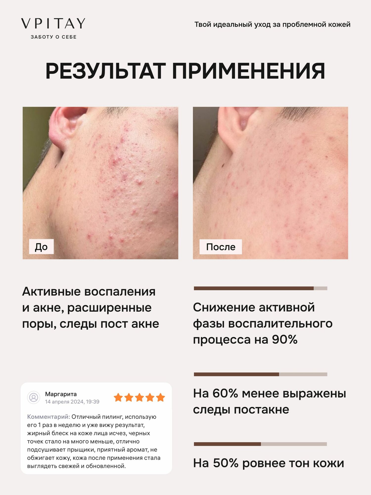 Картинки Пилинг для лица кислотный от прыщей профессиональный с азелаиновой кислотой анти акне.