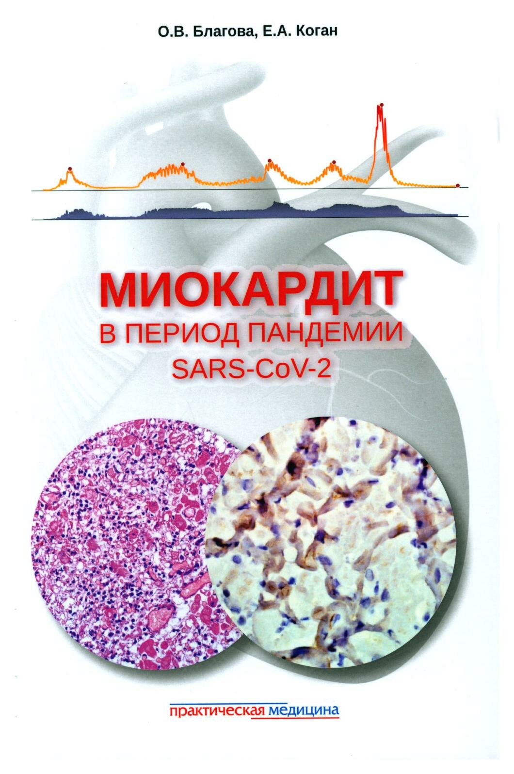 Миокардит в период пандемии SARS-CoV-2 - фото №1