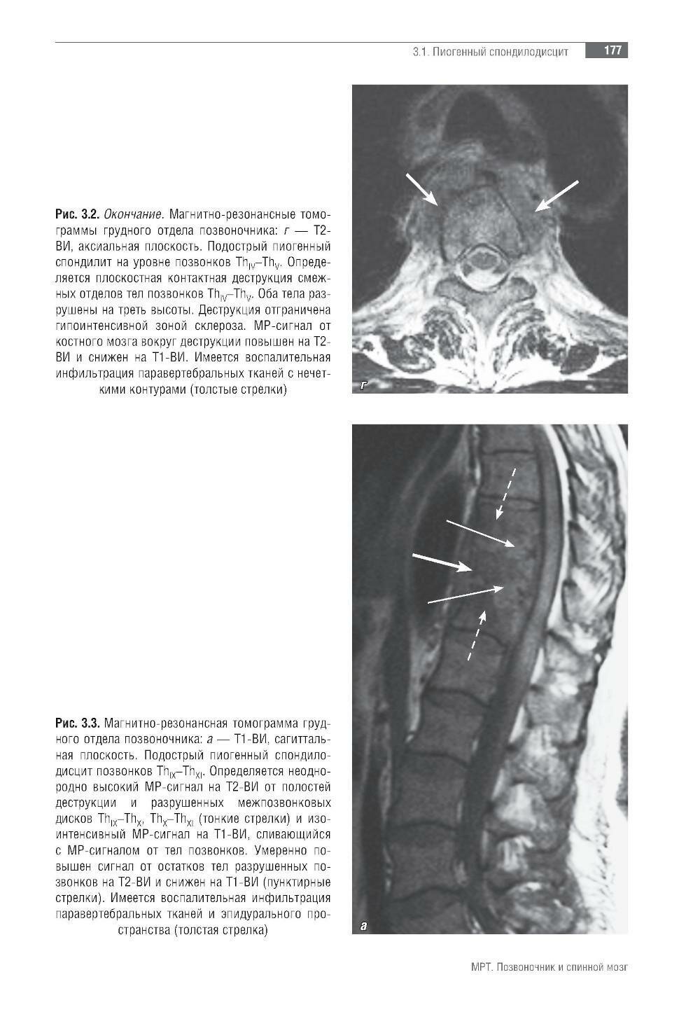 МРТ. Позвоночник и спинной мозг - фото №17