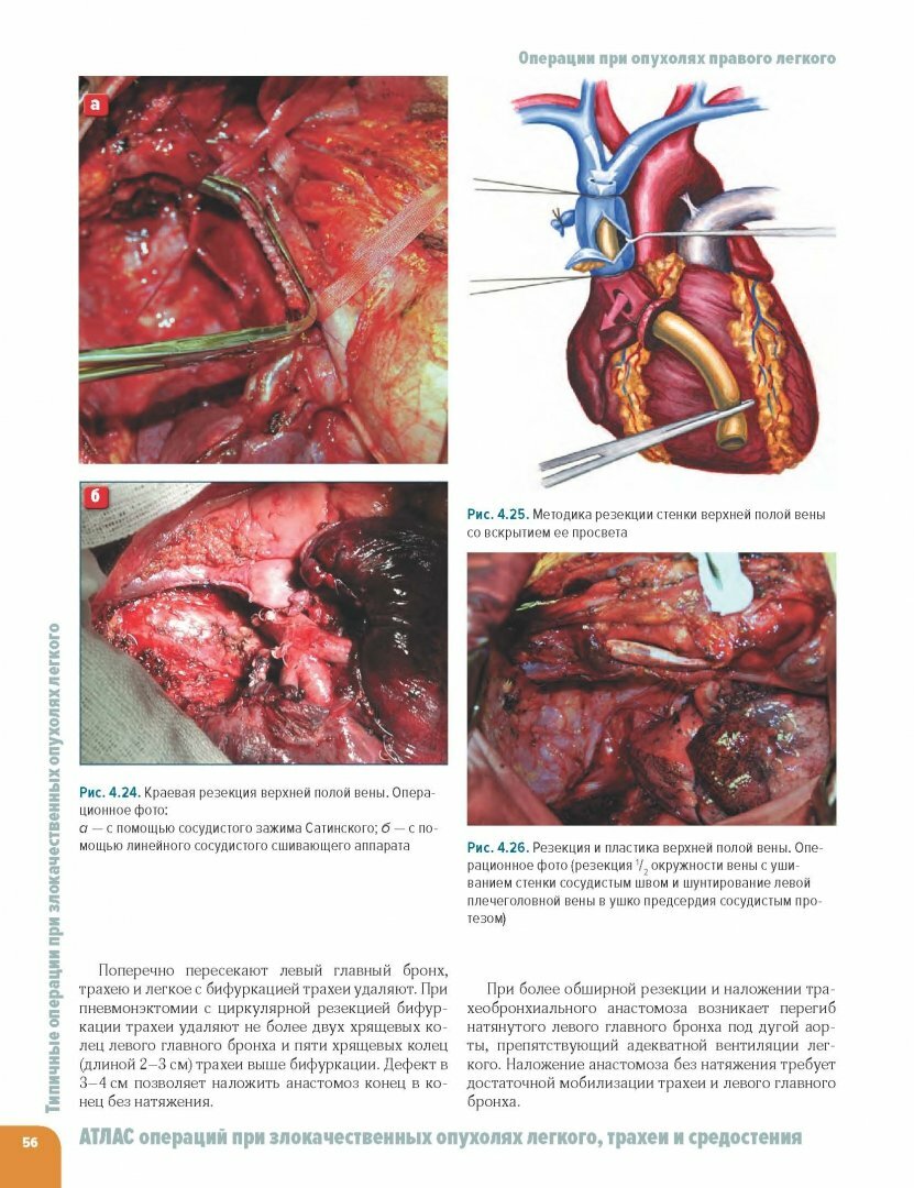 Атлас операций при злокачественных опухолях легкого, трахеи и средостения - фото №13