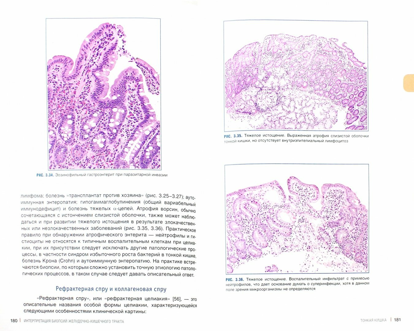 Интерпретация биопсий желудочно-кишечного тракта. Том 1. Неопухолевые болезни - фото №13