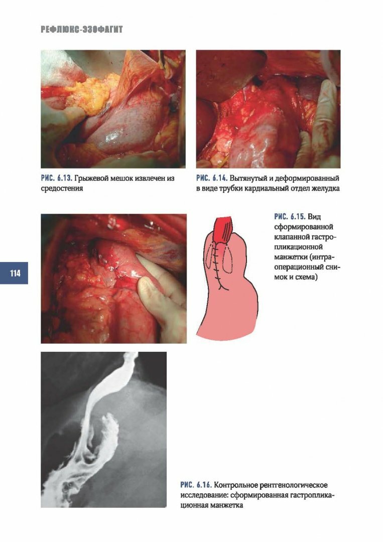 Рефлюкс-эзофагит (Черноусов Александр Федорович, Хоробрых Татьяна Витальевна, Ветшев Федор Петрович) - фото №11